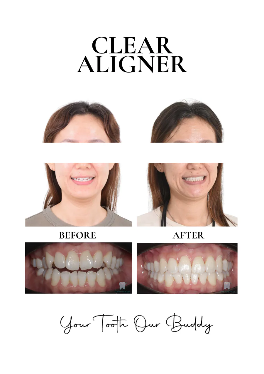 Clear aligner treatment result 1, before and after comparison.