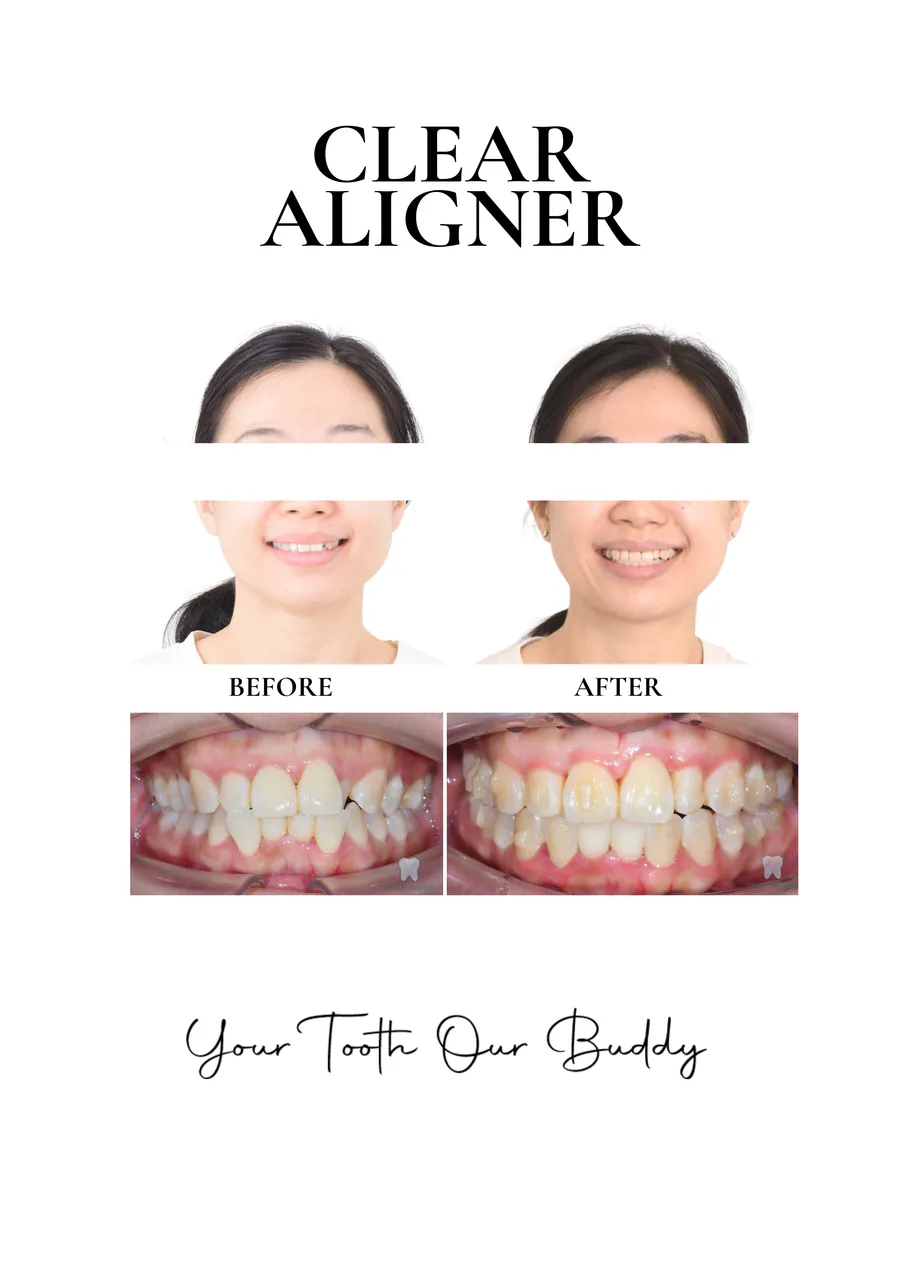 Clear aligner treatment result 2, before and after comparison.