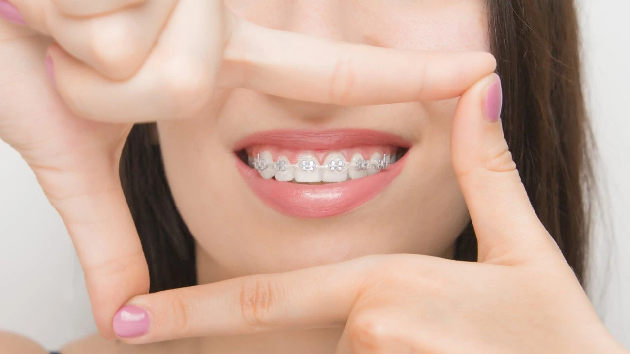Self-Ligating Braces