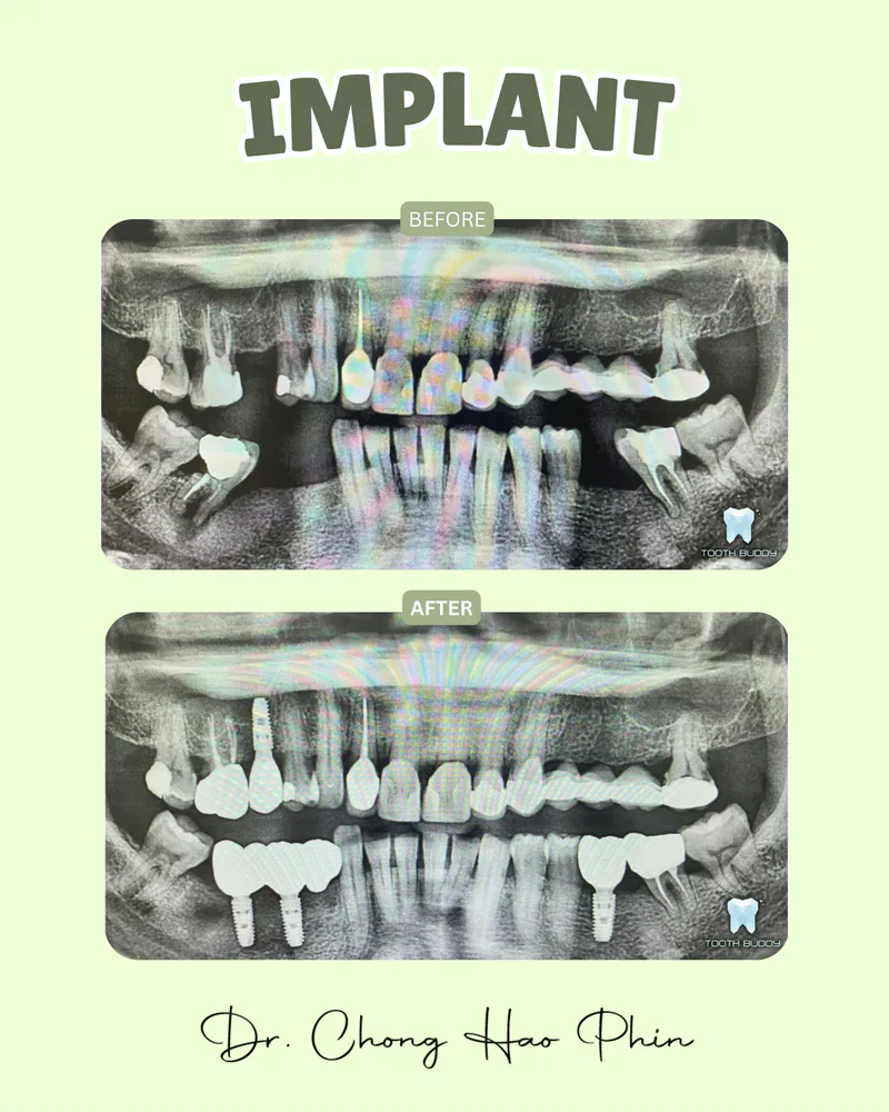Dental implant treatment result 2, before and after comparison.