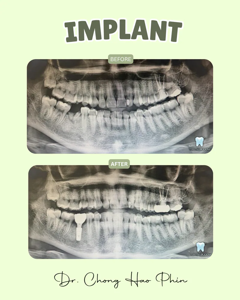 Dental implant treatment result 3, before and after comparison.