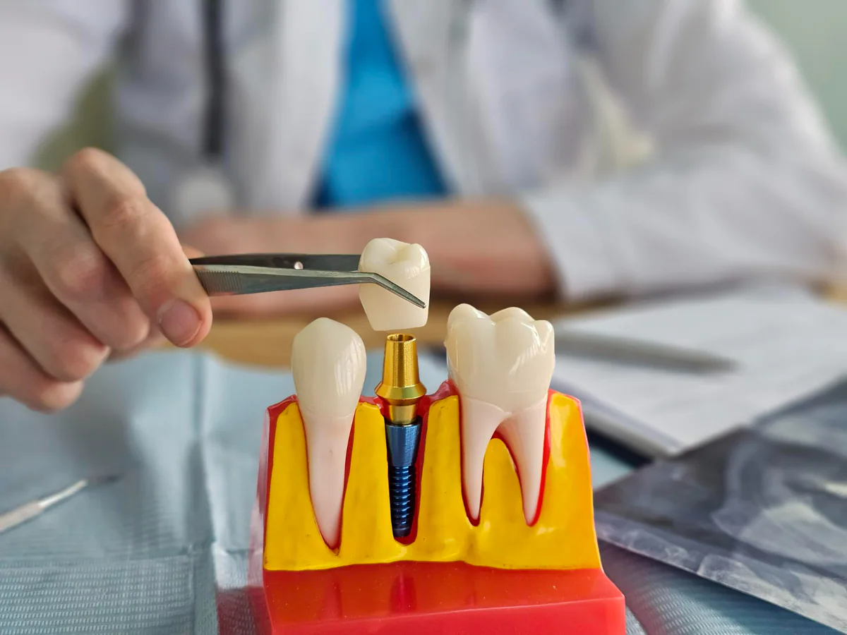 Dental implants suit adults with missing teeth seeking a fixed replacement option.