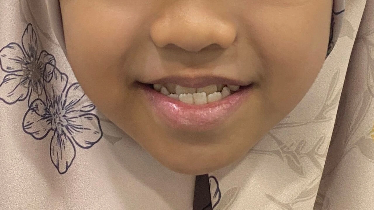 Child receiving early orthodontic treatment